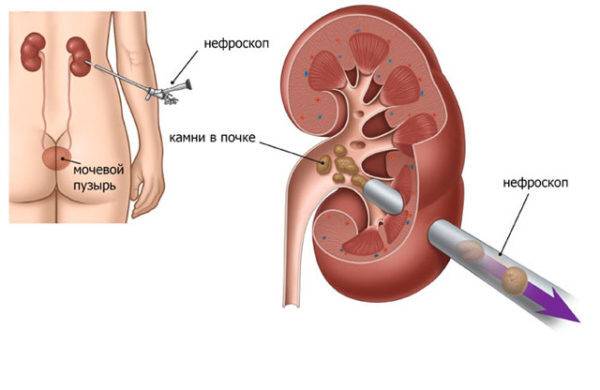 Лечение почек: чем лечить у мужчин и женщин, как вылечить народными средствами