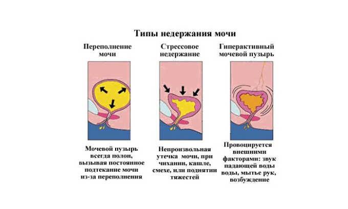 В случае перерастяжения органа появляется интенсивная боль. Причина - накопление большого количества мочи при затруднении ее вывода