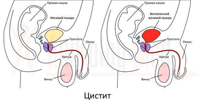 Почему моча с кровью у мужчин: причины, диагностика, лечение гематурии