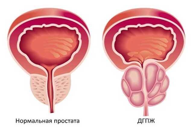 Как влияет эякуляция на аденому простаты: польза и вред от мастурбации, можно ли заниматься сексом, а также влияние заболевания на потенцию и сексуальную жизнь