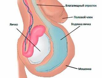 Оперирование гидроцеле
