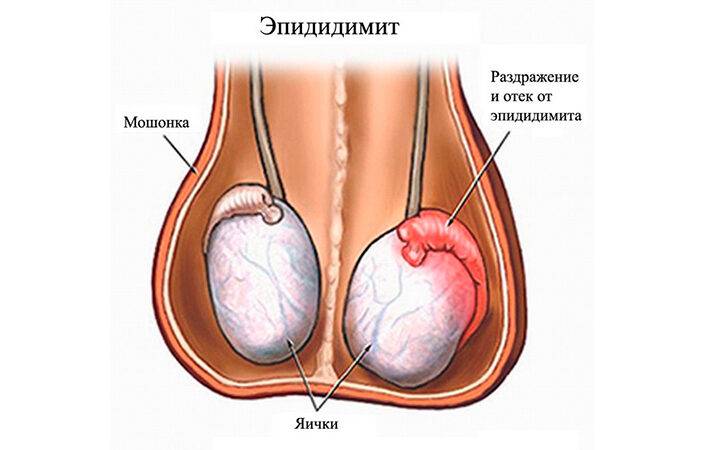 Опухло яичко у мужчины причины лечение