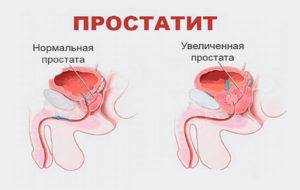 Гиперплазия предстательной железы - симптомы, лечение