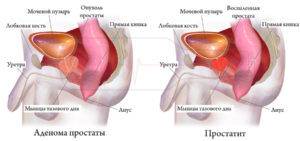 Доброкачественная опухоль предстательной железы у мужчин