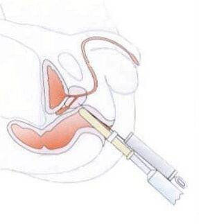 Брахитерапия предстательной железы