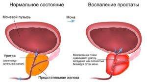 Доброкачественная опухоль предстательной железы у мужчин