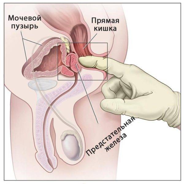 Не стоит бояться пальцевого ректального обследования