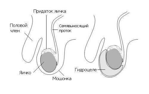 Опухли яички и болят у мужчины: причины, почему отекает мошонка, как лечить