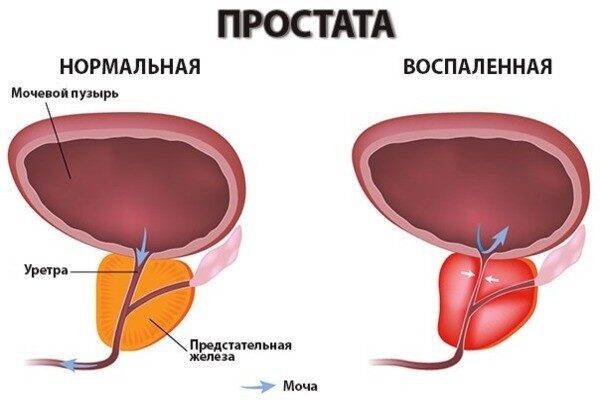 Диффузные изменения паренхимы предстательной железы: что это такое и какое лечение предстоит, а также о чем говорят повышенная эхогенность простаты, изоэхогенные и гиперэхогенные образования