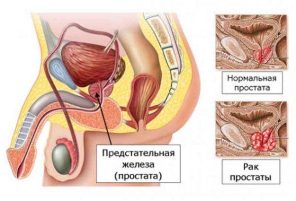 Повышенный уровень тестостерона может привести к развитию рака простаты