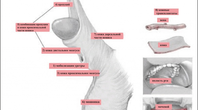 Гипоспадия – операция, головчатая и стволовая гипоспадия у мальчиков