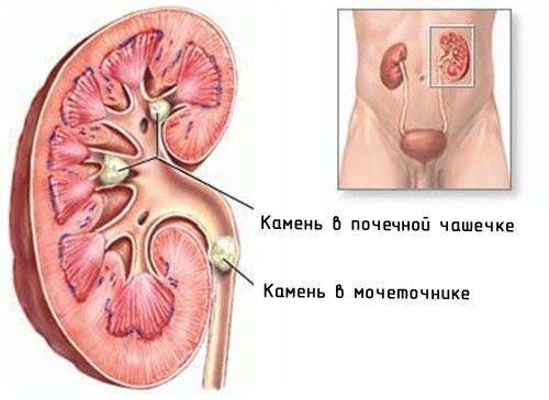 Слизь в моче - что это значит, как от нее избавиться?