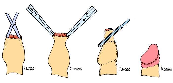 Операция по удалению крайней плоти
