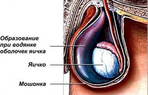 Шишечки на мошонке