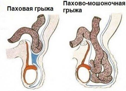 Шишечки на мошонке