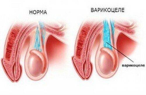 Шишечки на мошонке