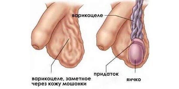 Варикоцеле: причины, признаки, постановка диагноза и методы лечения болезни у мужчин