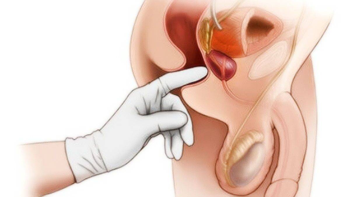 Смешанная эхогенность предстательной железы