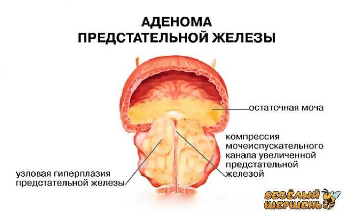 Прополис для лечения простатита и аденомы простаты