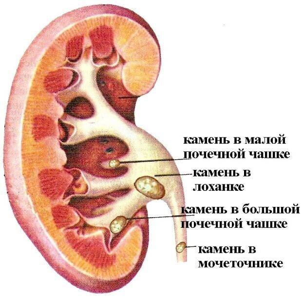 Болит почка с правой стороны: симптомы, лечение в домашних условиях