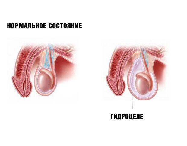 Водянка яичек у мужчин: операция и ее последствия, возможен ли рецидив гидроцеле, фото до и после