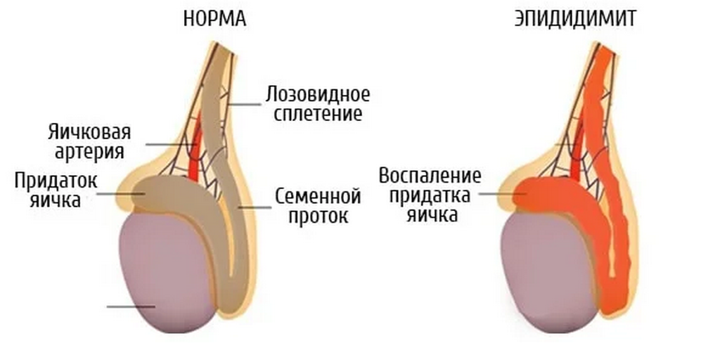 Классификация воспалений яичек у мужчин