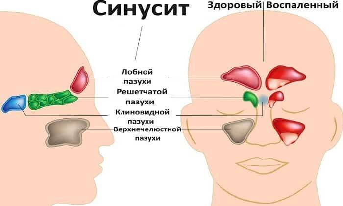 Ломфлокс назначают при простатите