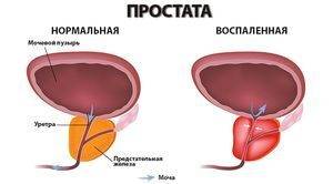 Кальцинаты в предстательной железе: описание симптомов и способов лечения, народные средства, а также какие последствия, если не лечить кальциноз простаты