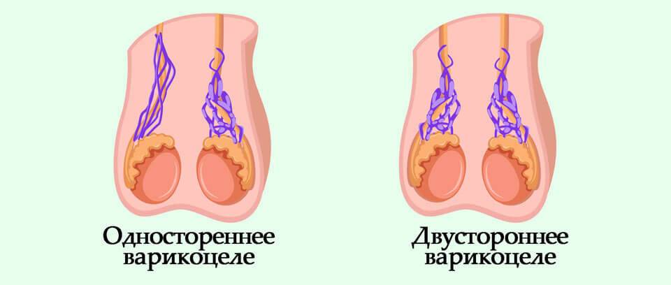 Варикоцеле у мужчин