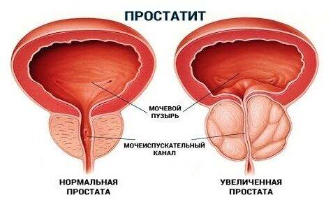 Аппараты для лечения простатита в домашних условиях: самые эффективные медицинские приборы и физиоаппараты для домашнего аппаратного лечения