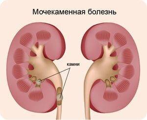 Как отличить боль в почках: первые признаки и симптомы