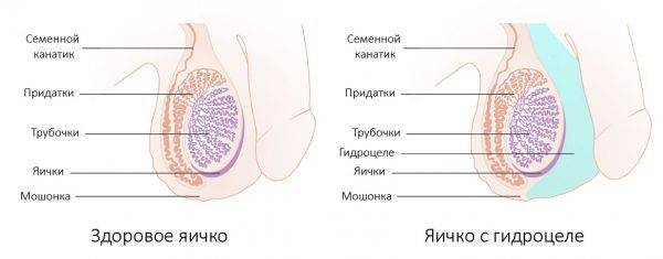 Перекрут семенного канатика яичка