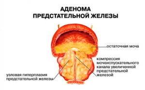 Диагностика заболеваний предстательной железы