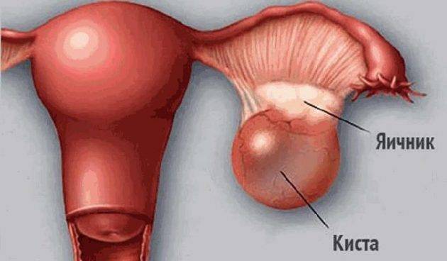 Киста яичника в пожилом возрасте причины