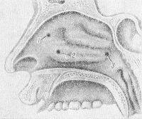Рис. 6. Схематическое изображение боковой стенки полости носа (сагиттальный разрез) с указанием мест (1, 2, 3) введения раствора новокаина при внутрино-совой блокаде: 1 — кпереди от переднего конца средней раковины, 2 — в переднем и 3 — в заднем отделах нижней раковины.