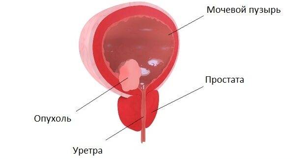 Болит мочевой пузырь - причины у мужчины и женщины, симптомы, чем лечить