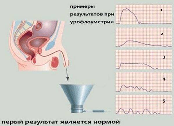 Урофлоуметрия