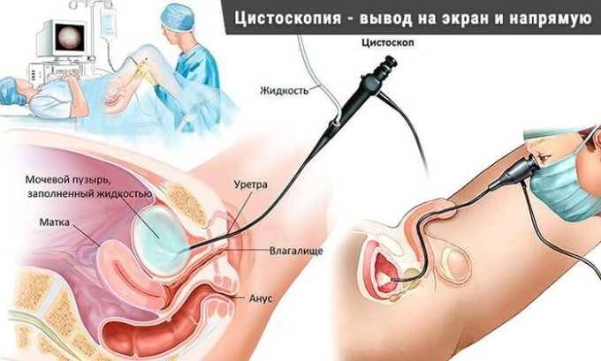 Клиническая картина лейкоплакии сходна с таковой при цистите. При осмотре органа (цистоскопии) обнаруживаются белесоватые участки с четкими границами