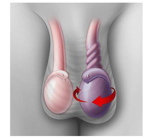 Как происходит перекрут яичка