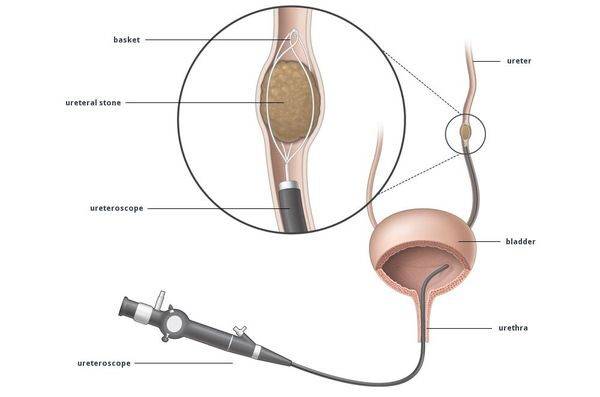 Трансуретральная контактная литотрипсия