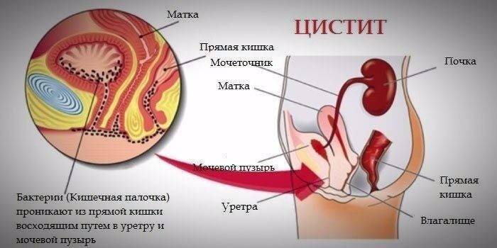 Схематическое описание болезни