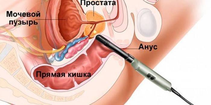 Биопсия предстательной железы, как проводится процедура биопсии простаты мужчинам, расшифровка результатов анализа