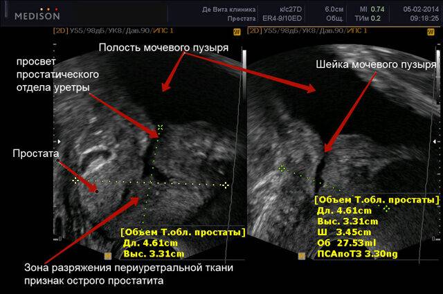 Расшифровка результатов УЗИ предстательной железы: принятые нормы