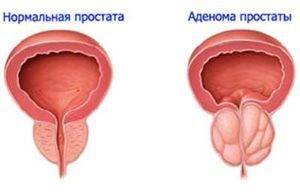 Частое мочеиспускание у мужчин – нельзя пропустить эти симптомы