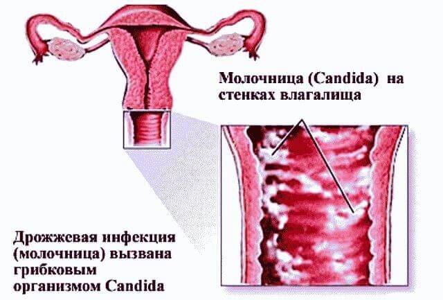 Таблетки от молочницы для мужчин: ТОП 7 эффективных препаратов от мужского кандидоза