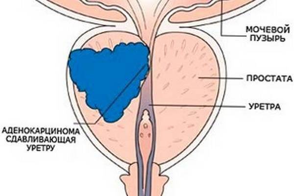 Чаще всего встречается аденокарцинома