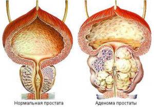 Гиперплазия предстательной железы - симптомы, лечение