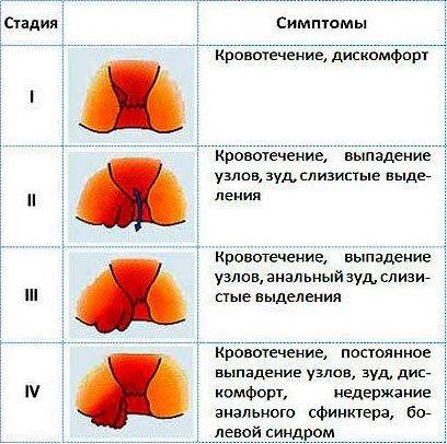 Симптомы и лечение геморроя у мужчин – чем опасен геморрой у мужчин