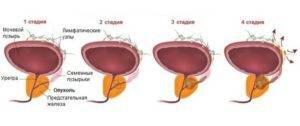 Гиперплазия предстательной железы - симптомы, лечение