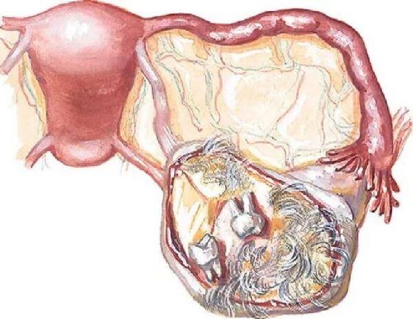 Киста яичника в пожилом возрасте причины